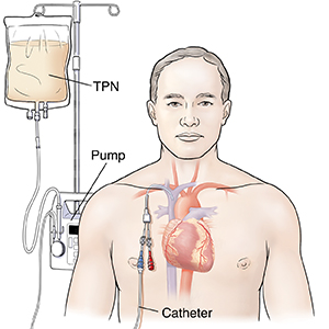 Total Parenteral Nutrition TPN